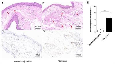 Comparative Transcriptomic Analysis to Identify the Important Coding and Non-coding RNAs Involved in the Pathogenesis of Pterygium